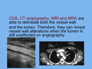 CDS, CT angiography, MRI and MRA are 
able to delineate both the vessel wall 
and the lumen. Therefore, they can reveal 
vessel wall alterations when the lumen is 
still unaffected on angiography 
 