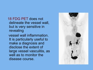 Imaging of vasculitis | PPT