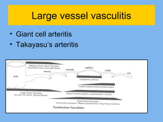 Large vessel vasculitis 
• Giant cell arteritis 
• Takayasu’s arteritis 
 