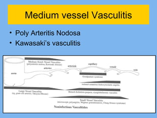 Medium vessel Vasculitis 
• Poly Arteritis Nodosa 
• Kawasaki’s vasculitis 
 