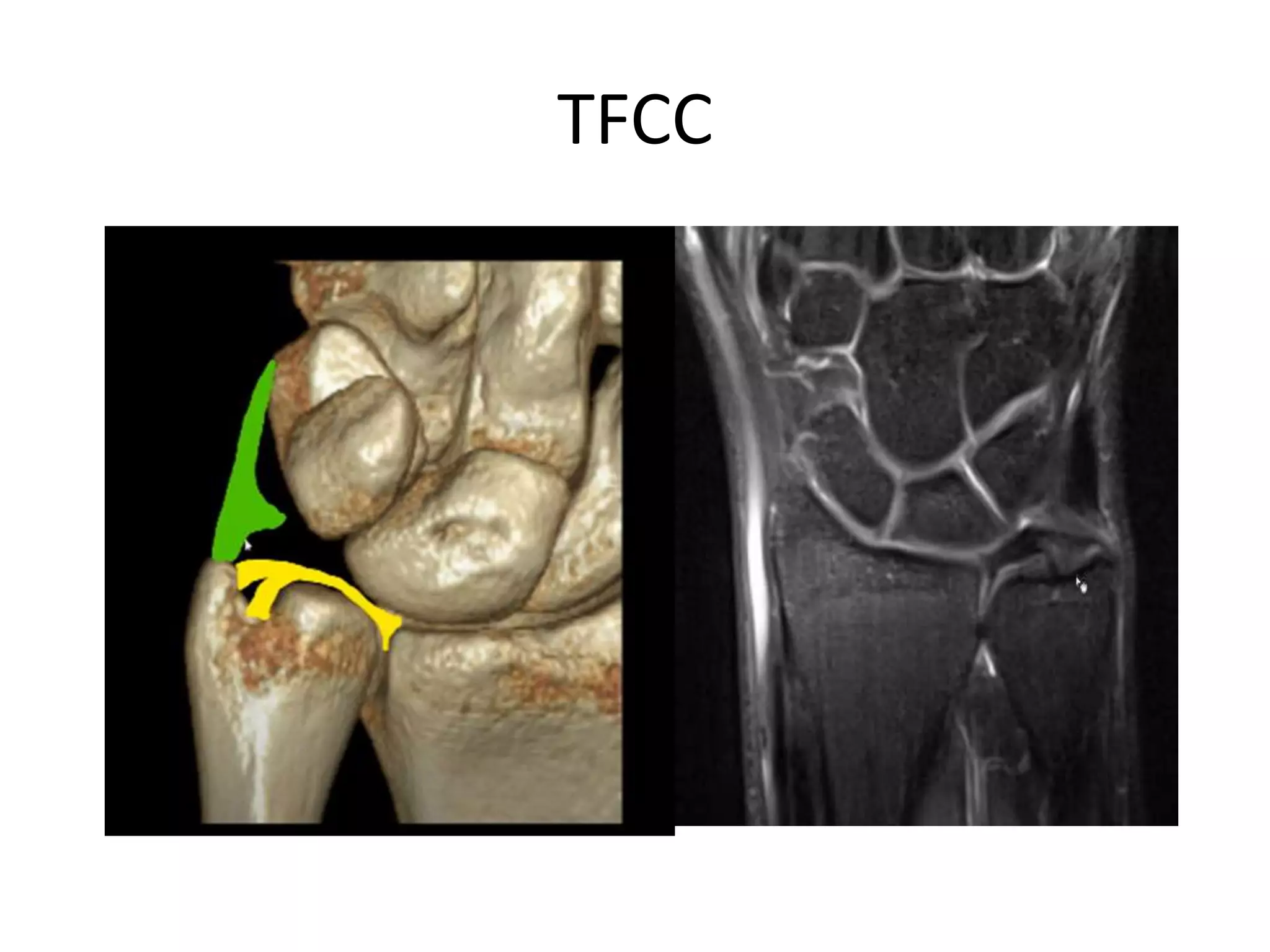 Imaging of wrist joint | PPTX
