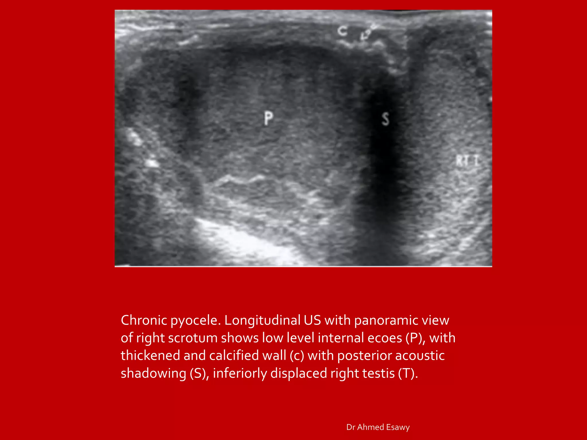 Imaging orchitis epidydmitis epidydmo orchitis DrAhmed Esawy | PDF