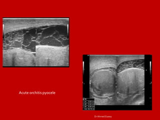 Imaging orchitis epidydmitis epidydmo orchitis DrAhmed Esawy | PDF