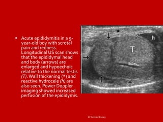 Orchitis Ct Imaging orchitis epidydmitis epidydmo orchitis DrAhmed Esawy | PDF