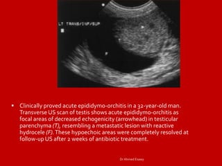 Orchitis Ct Imaging orchitis epidydmitis epidydmo orchitis DrAhmed Esawy | PDF