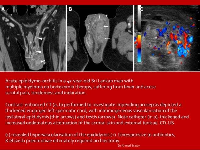 Imaging orchitis epidydmitis epidydmo orchitis DrAhmed Esawy