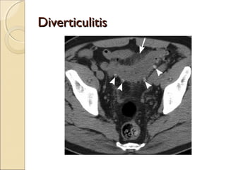 Imaging in acute abdominal pain | PPT