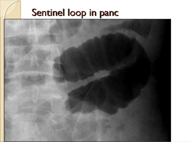 Sentinel Loop C++