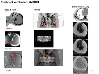Imaging for Radiotherapy delivery and verification | PDF
