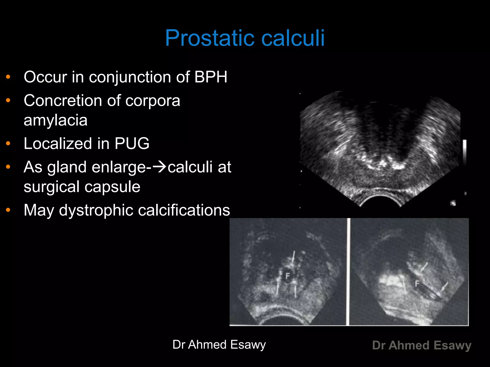 Prostate Calcification Imaging prostatitis ,urethritis Dr Ahmed Esawy | PDF