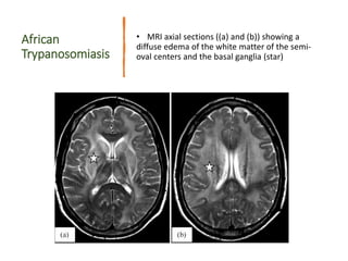 Imaging RADIOKLOGY and US for Protozoal Diseases.pptx