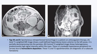 Traumatic Reticuloperitonitis Rads Radiological Imaging of Retroperitoneum.pptx