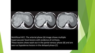 IMAGING SPECTRUM OF HCC | PPTX