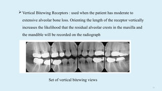 2 6
Vertical Bitewing Receptors : used when the patient has moderate to
extensive alveolar bone loss. Orienting the length of the receptor vertically
increases the likelihood that the residual alveolar crests in the maxilla and
the mandible will be recorded on the radiograph
Set of vertical bitewing views
 