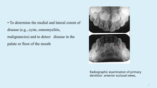 2 9
• To determine the medial and lateral extent of
disease (e.g., cysts, osteomyelitis,
malignancies) and to detect disease in the
palate or floor of the mouth
Radiographic examination of primary
dentition anterior occlusal views,
 