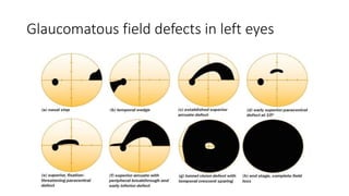 Glaucomatous field defects in left eyes
 