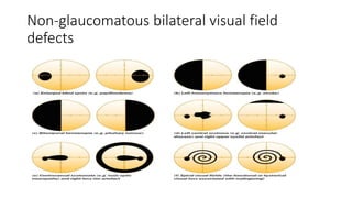 Non-glaucomatous bilateral visual field
defects
 