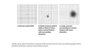 Amsler grid, when viewed by someone with normal central vision (a) and by people with a
problem with their central visual field (b and c)
 