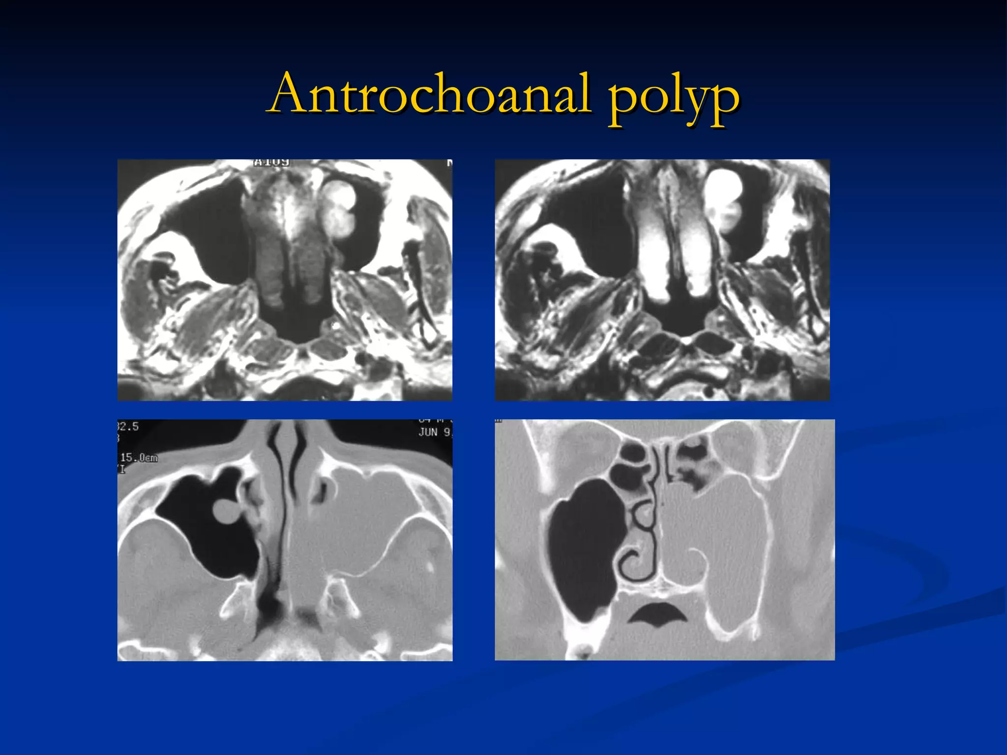 Imaging The Paranasal Sinuses. Iria 2008 | PPT