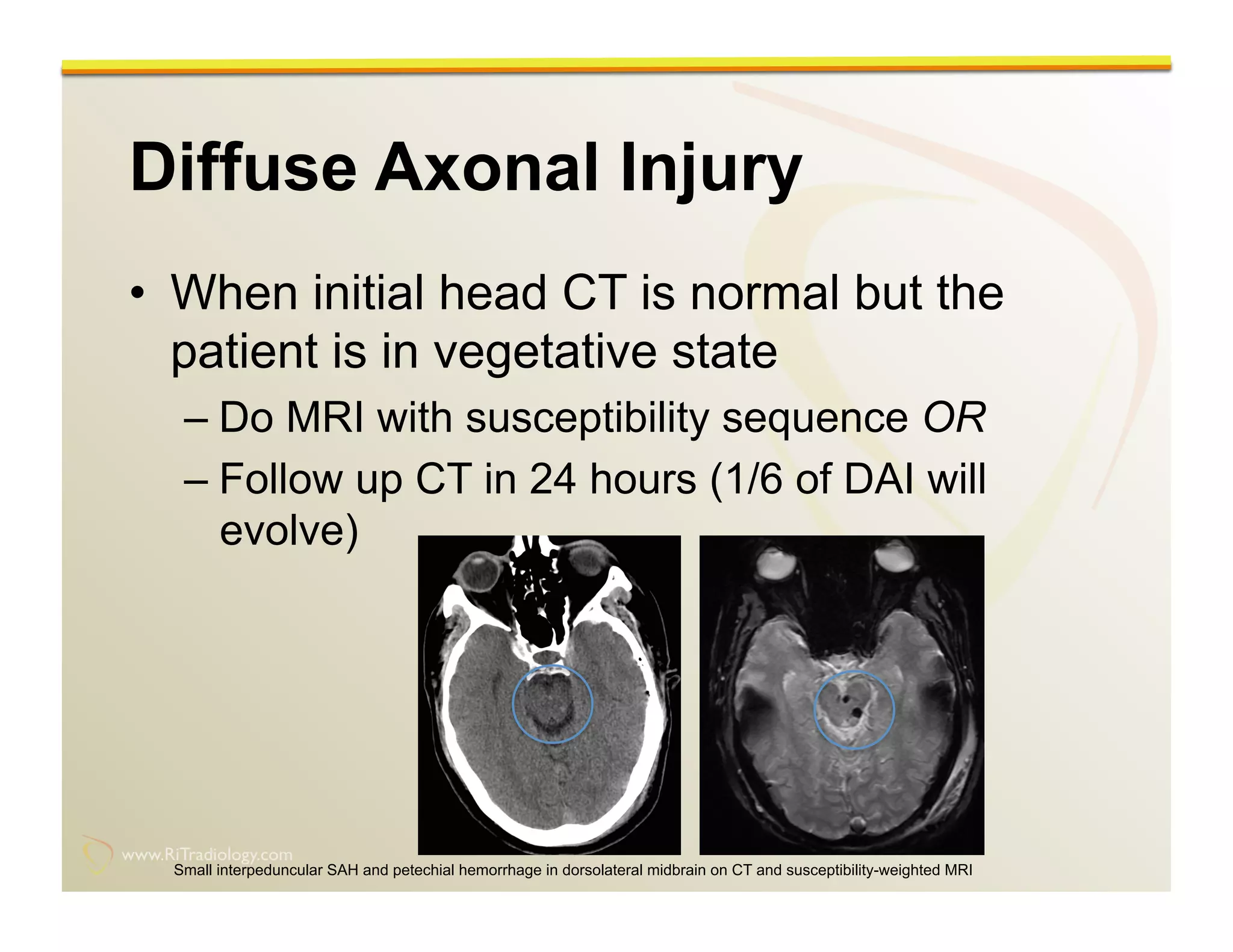 Imaging of the traumatic brain injury by Rathachai Kaewlai, MD | PDF