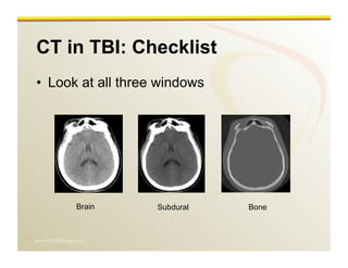 www.RiTradiology.com	

CT in TBI: Checklist
•  Look at all three windows
Brain Subdural Bone
 