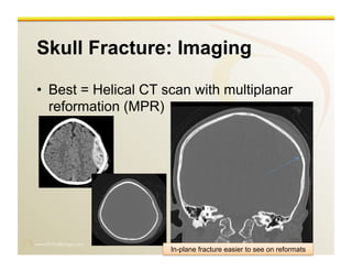 www.RiTradiology.com	

Skull Fracture: Imaging
•  Best = Helical CT scan with multiplanar
reformation (MPR)
In-plane fracture easier to see on reformats
 