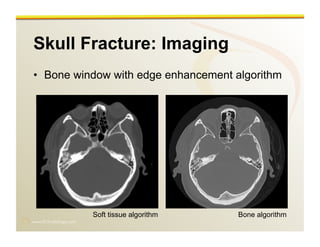 www.RiTradiology.com	

Skull Fracture: Imaging
•  Bone window with edge enhancement algorithm
Soft tissue algorithm Bone algorithm
 