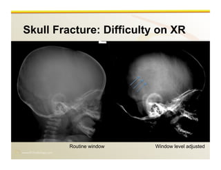 www.RiTradiology.com	

Skull Fracture: Difficulty on XR
Window level adjustedRoutine window
 