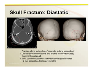 www.RiTradiology.com	

Skull Fracture: Diastatic
• Fracture along suture lines “traumatic sutural separation”
• Usually affected newborns and infants (unfused sutures)
• Commonly unilateral
• Most common location = lambdoid and sagittal sutures
• >2 mm separation that is asymmetric
 