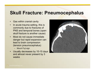 www.RiTradiology.com	

Skull Fracture: Pneumocephalus
•  Gas within cranial cavity
•  In acute trauma setting, this is
commonly due to fractures of
PNS and temporal bones (open
skull fracture is another cause)
•  Most do not cause immediate
danger but rapid expansion can
lead to brain compression
(tension pneumocephalus)
–  Mount Fuji sign
•  Usually decreases by 10-15 days
and almost never present by 3
weeks
 