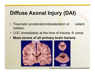 www.RiTradiology.com	

Diffuse Axonal Injury (DAI)
•  Traumatic acceleration/deceleration or violent
rotation
•  LOC immediately at the time of trauma  coma
•  Most severe of all primary brain lesions
Images from http://www.pathguy.com/bryanlee/dai.htm
 