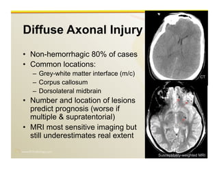 www.RiTradiology.com	

Diffuse Axonal Injury
•  Non-hemorrhagic 80% of cases
•  Common locations:
–  Grey-white matter interface (m/c)
–  Corpus callosum
–  Dorsolateral midbrain
•  Number and location of lesions
predict prognosis (worse if
multiple & supratentorial)
•  MRI most sensitive imaging but
still underestimates real extent
Susceptibility-weighted MRI
CT
 