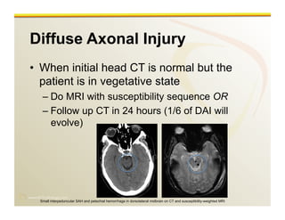 www.RiTradiology.com	

Diffuse Axonal Injury
•  When initial head CT is normal but the
patient is in vegetative state
– Do MRI with susceptibility sequence OR
– Follow up CT in 24 hours (1/6 of DAI will
evolve)
Small interpeduncular SAH and petechial hemorrhage in dorsolateral midbrain on CT and susceptibility-weighted MRI
 