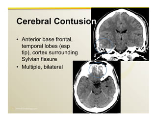 www.RiTradiology.com	

Cerebral Contusion
•  Anterior base frontal,
temporal lobes (esp
tip), cortex surrounding
Sylvian fissure
•  Multiple, bilateral
 