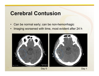 www.RiTradiology.com	

Cerebral Contusion
•  Can be normal early; can be non-hemorrhagic
•  Imaging worsened with time, most evident after 24 h
Day 0 Day 1
 