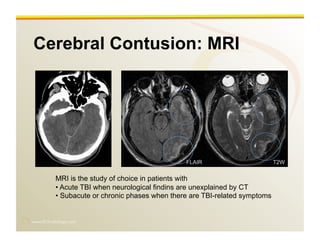 www.RiTradiology.com	

Cerebral Contusion: MRI
FLAIR T2W
MRI is the study of choice in patients with
• Acute TBI when neurological findins are unexplained by CT
• Subacute or chronic phases when there are TBI-related symptoms
 