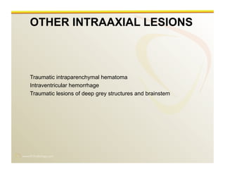 www.RiTradiology.com	

OTHER INTRAAXIAL LESIONS
Traumatic intraparenchymal hematoma
Intraventricular hemorrhage
Traumatic lesions of deep grey structures and brainstem
 