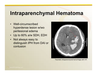 www.RiTradiology.com	

Intraparenchymal Hematoma
•  Well-circumscribed
hyperdense lesion w/wo
perilesional edema
•  Up to 60% a/w SDH, EDH
•  Not always easy to
distinguish IPH from DAI or
contusion
Traumatic intraparenchymal hemorrhage with IVH
 