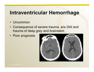 www.RiTradiology.com	

Intraventricular Hemorrhage
•  Uncommon
•  Consequence of severe trauma. a/w DAI and
trauma of deep grey and brainstem
•  Poor prognosis
 