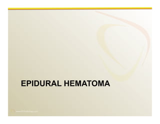 www.RiTradiology.com	

EPIDURAL HEMATOMA
 