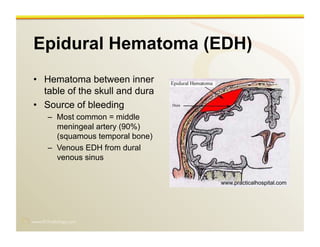 www.RiTradiology.com	

Epidural Hematoma (EDH)
•  Hematoma between inner
table of the skull and dura
•  Source of bleeding
–  Most common = middle
meningeal artery (90%)
(squamous temporal bone)
–  Venous EDH from dural
venous sinus
www.practicalhospital.com
 