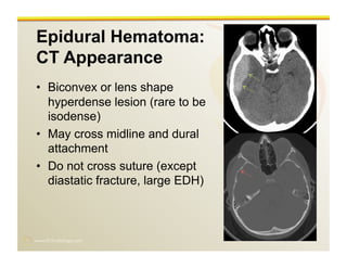 www.RiTradiology.com	

Epidural Hematoma:
CT Appearance
•  Biconvex or lens shape
hyperdense lesion (rare to be
isodense)
•  May cross midline and dural
attachment
•  Do not cross suture (except
diastatic fracture, large EDH)
 