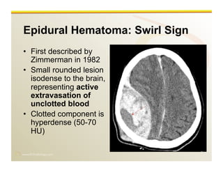 www.RiTradiology.com	

Epidural Hematoma: Swirl Sign
•  First described by
Zimmerman in 1982
•  Small rounded lesion
isodense to the brain,
representing active
extravasation of
unclotted blood
•  Clotted component is
hyperdense (50-70
HU)
 