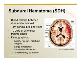 www.RiTradiology.com	

Subdural Hematoma (SDH)
•  Blood collects between
dura and arachnoid
•  Torn cortical bridging veins
•  10-20% of all cranial
trauma cases
•  Demographics:
–  Elderly (60-80y) with brain
atrophy,
–  Large intracranial
subarachnoid spaces
–  “Shaken baby syndrome”
www.nucleusinc.com
 