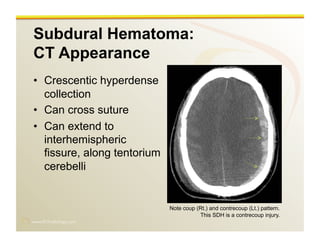 www.RiTradiology.com	

Subdural Hematoma:
CT Appearance
•  Crescentic hyperdense
collection
•  Can cross suture
•  Can extend to
interhemispheric
fissure, along tentorium
cerebelli
Note coup (Rt.) and contrecoup (Lt.) pattern.
This SDH is a contrecoup injury.
 