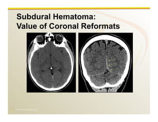 www.RiTradiology.com	

Subdural Hematoma:
Value of Coronal Reformats
 