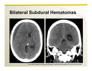 www.RiTradiology.com	

Bilateral Subdural Hematomas
Don’t feel “enough” with trauma findings. There’re almost always more to be discovered.
 