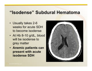 www.RiTradiology.com	

“Isodense” Subdural Hematoma
•  Usually takes 2-6
weeks for acute SDH
to become isodense
•  At Hb 8-10 g/dL, blood
will be isodense to
grey matter
•  Anemic patients can
present with acute
isodense SDH
 