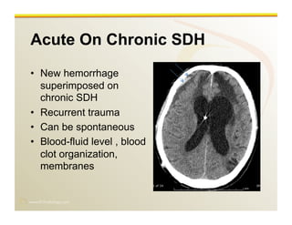 www.RiTradiology.com	

Acute On Chronic SDH
•  New hemorrhage
superimposed on
chronic SDH
•  Recurrent trauma
•  Can be spontaneous
•  Blood-fluid level , blood
clot organization,
membranes
 