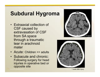 www.RiTradiology.com	

Subdural Hygroma
•  Extraaxial collection of
CSF caused by
extravasation of CSF
from SA space
through a traumatic
tear in arachnoid
mater
•  Acute: Children >> adults
•  Subacute and chronic:
Following surgery for head
injuries in operative bed or
opposite site
1 week after injury
Day of injury
 